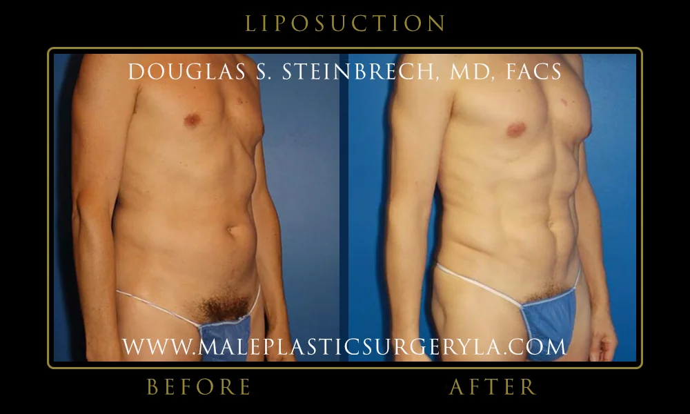 Liposuction - Before & After Photos