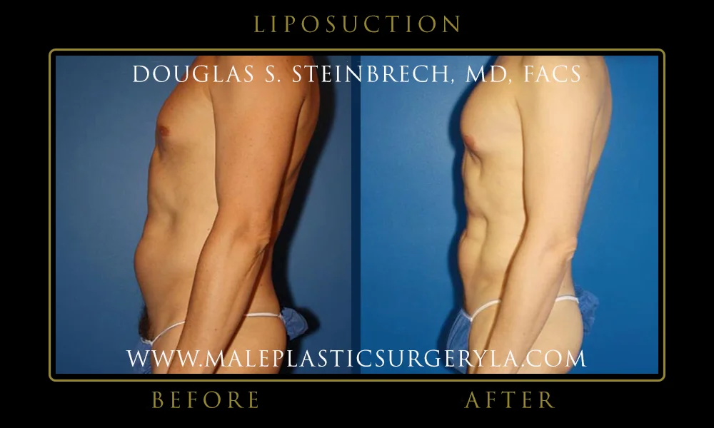 Liposuction - Before & After Photos