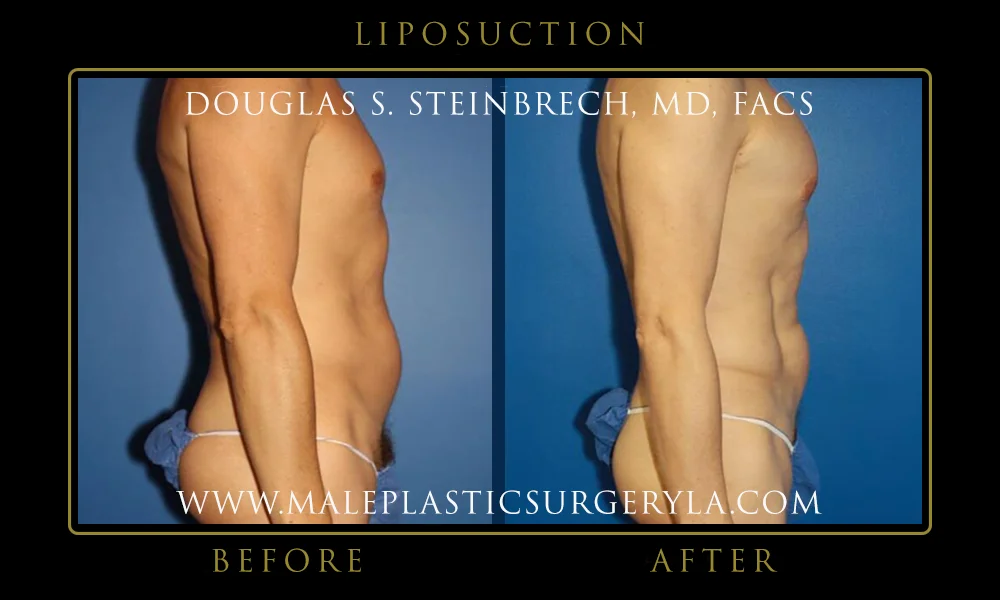 Liposuction - Before & After Photos