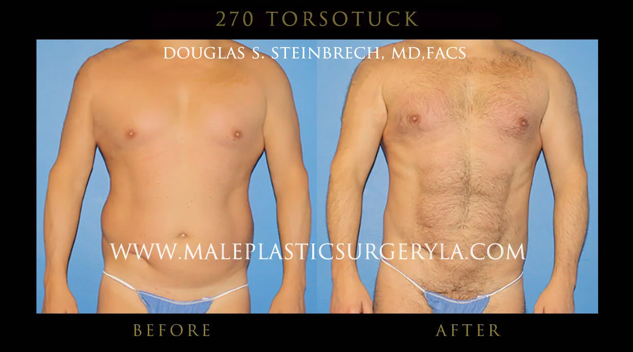 Torsotuck - Before & After Photos