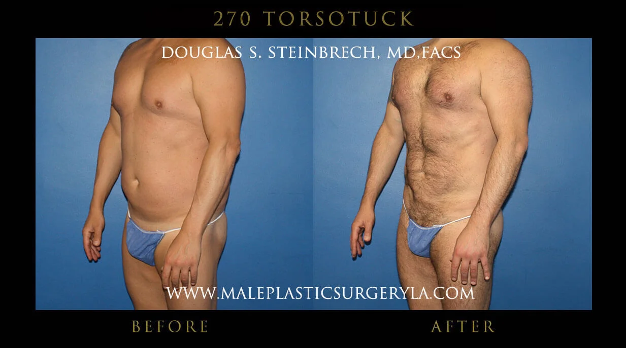 Torsotuck - Before & After Photos