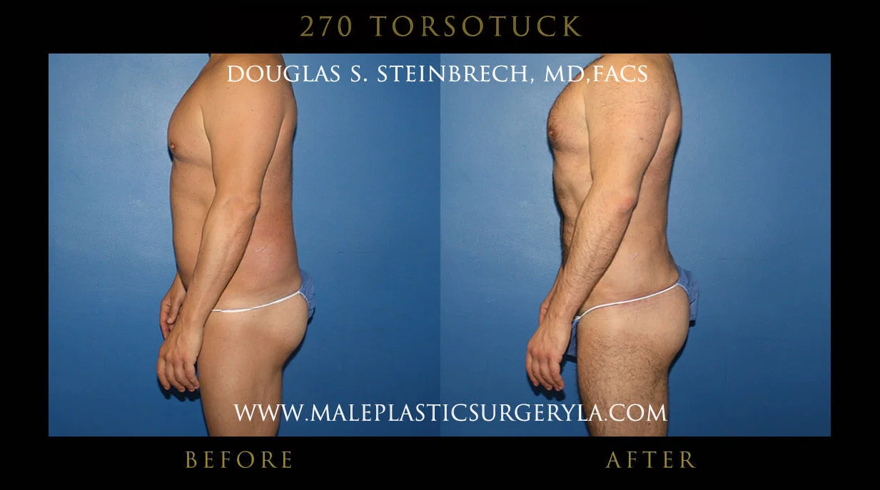 Torsotuck - Before & After Photos