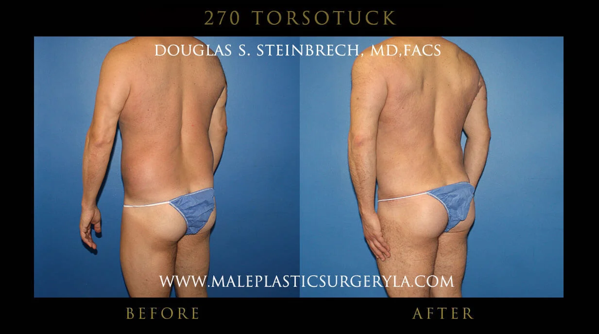 Torsotuck - Before & After Photos