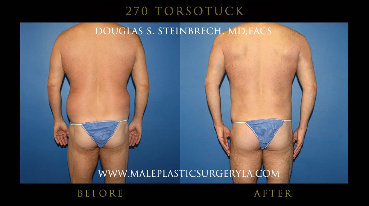 Torsotuck - Before & After Photos