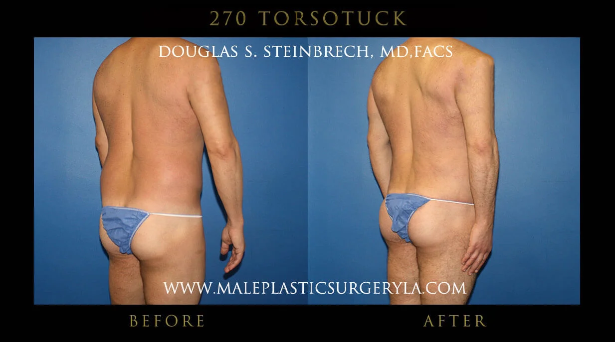 Torsotuck - Before & After Photos