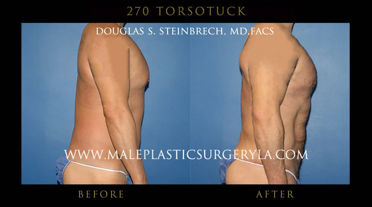 Torsotuck - Before & After Photos