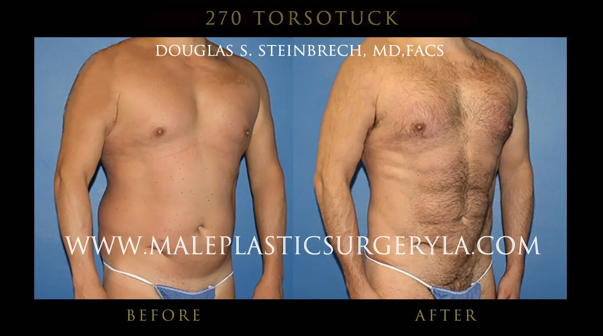 Torsotuck - Before & After Photos