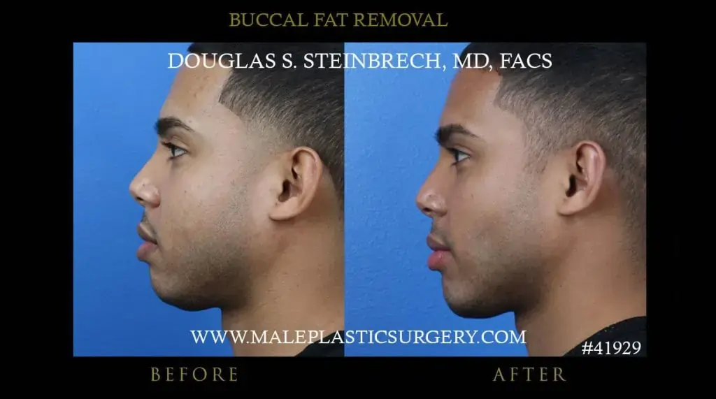 Buccal fat remova surgery 1 before and after photo left view -- Los alangeles