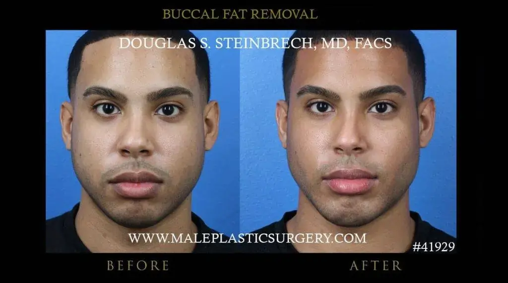 Buccal fat remova surgery before and after photo front view