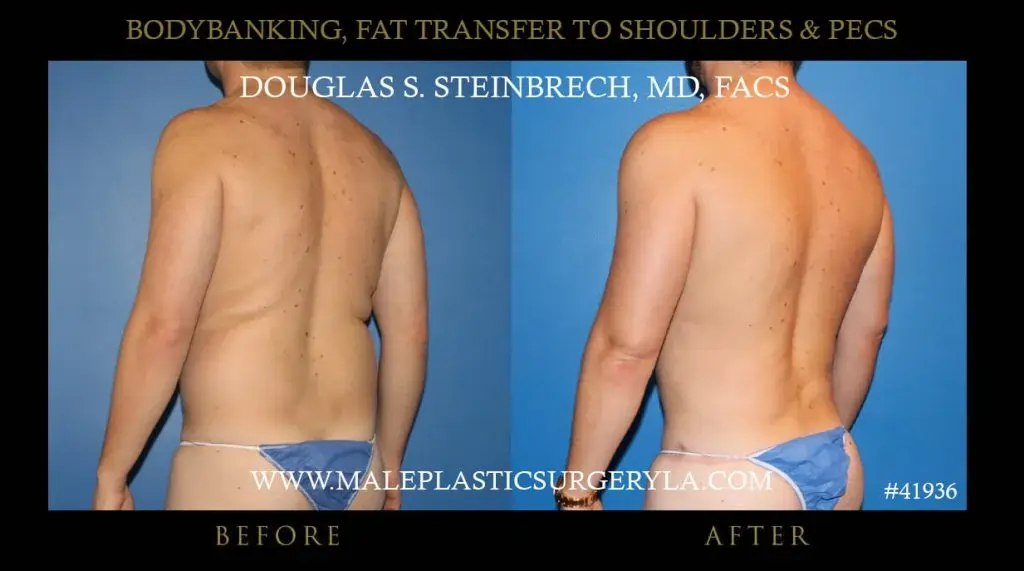 Body banking for men in LA, before and after photo -- left side