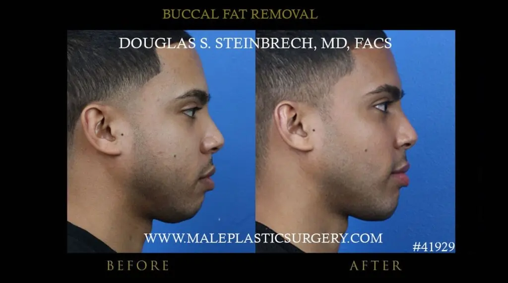 Buccal fat remova surgery before and after photo right view -- Los alangeles