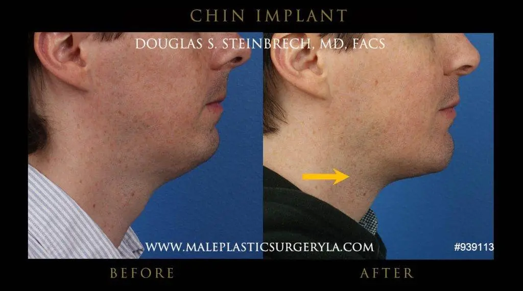 Chin implant surgery for men 