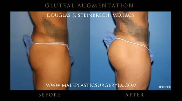 actor gluteal body enhancement enhancement before and after photos -right view