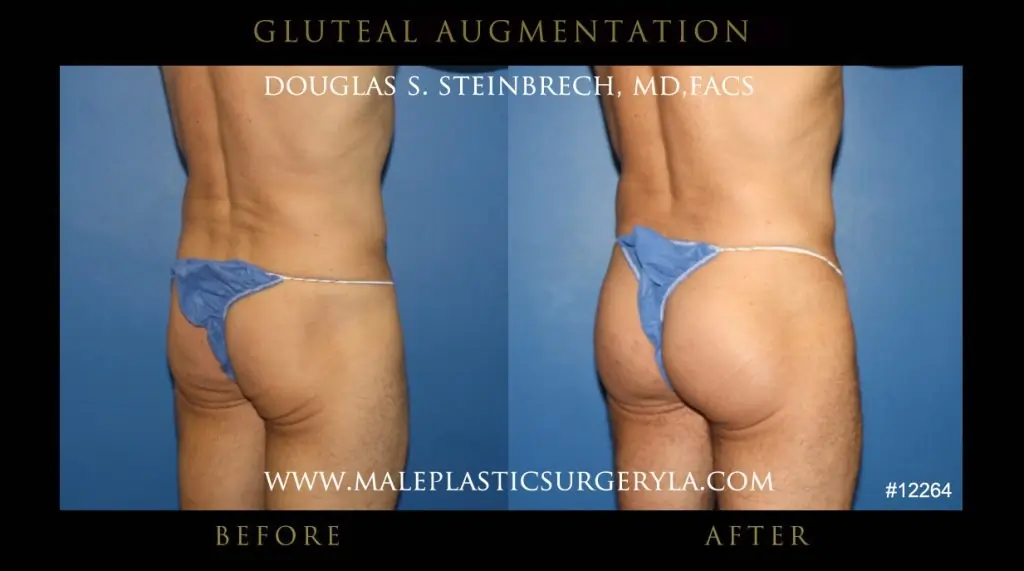 Gluteal enhancement for men before and after photo - right side