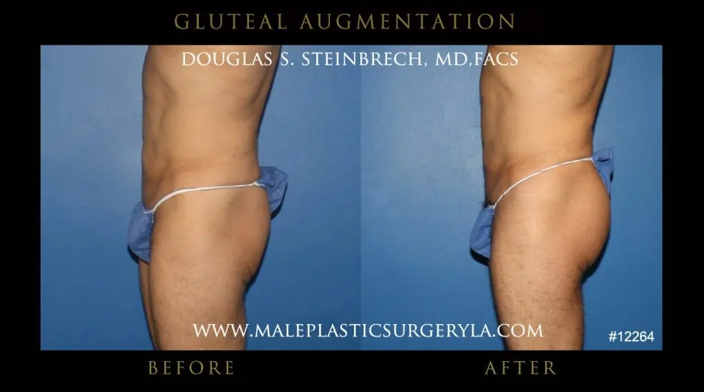 Gluteal enhancement for men before and after photo - left side