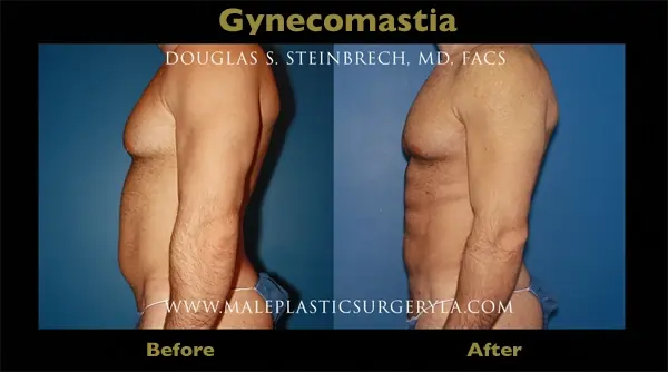 Gynecomastia surgery to remove man boobs