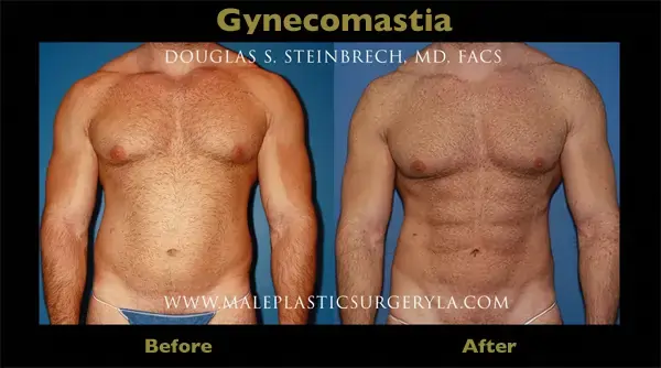 Gynecomastia surgery for men to remove man boobs at Male Plastic Surgery