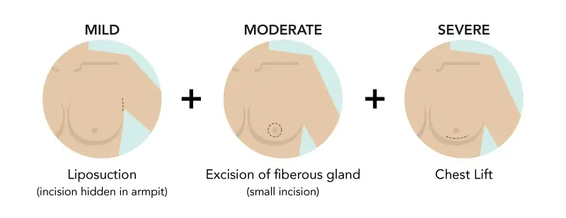 Gynecomastia surgery to remove man boobs - chart
