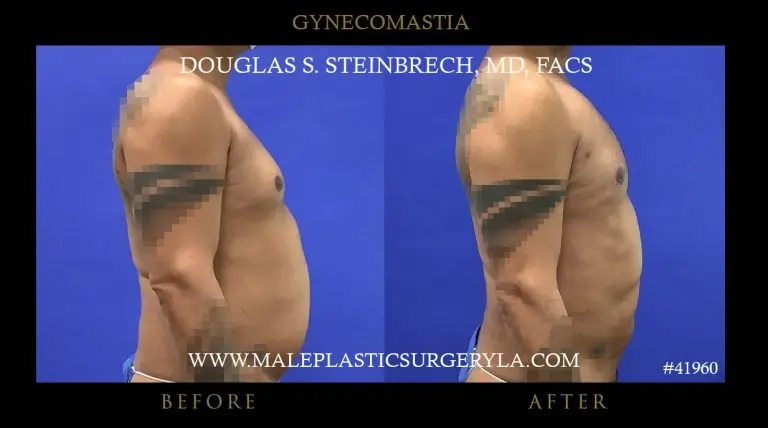 Gynecomastia surgery for men to remove man boobs shape