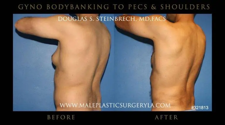 Gynecomastia plastic surgery to remove man boobs at Male Plastic Surgery before and after image
