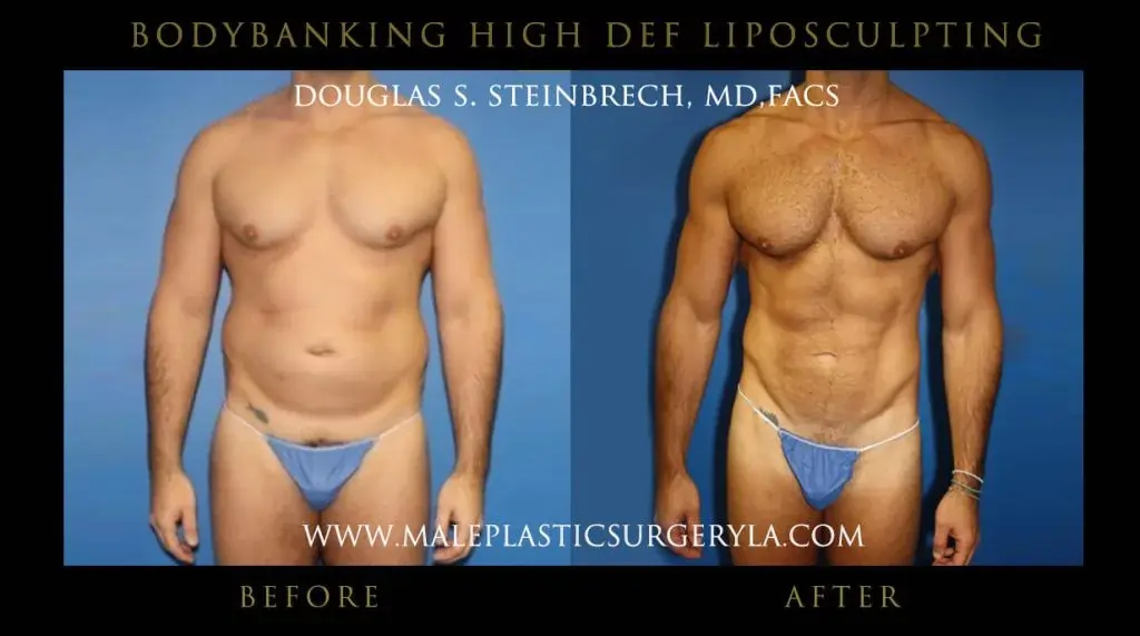 Hif def liposucrtion for men before and after photo -- front