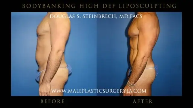 actor hi def liposuction body enhancement enhancement before and after photos -left view -