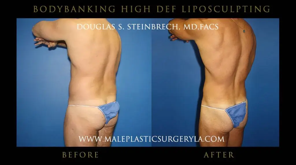 Hif def liposucrtion for men before and after photo -- partial left side performeed in LA
