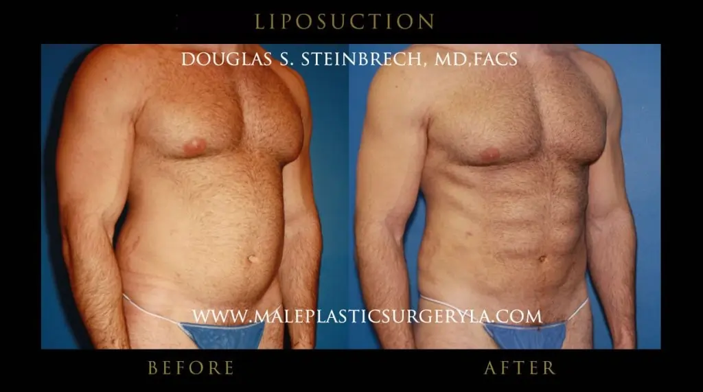 Liposuction procedure for men in Los angeles