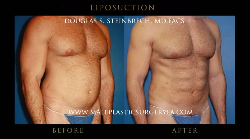 Liposuction For Your Love Handles, Beverly Hills