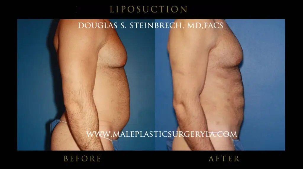 Liposuction procedure for men in Los angeles at male plastics surgery in Bevery hills, Califonia