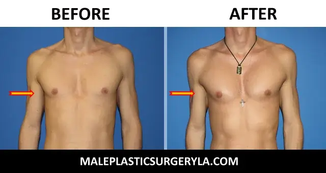 body implants for men enhance your appearence with a pectoral implant