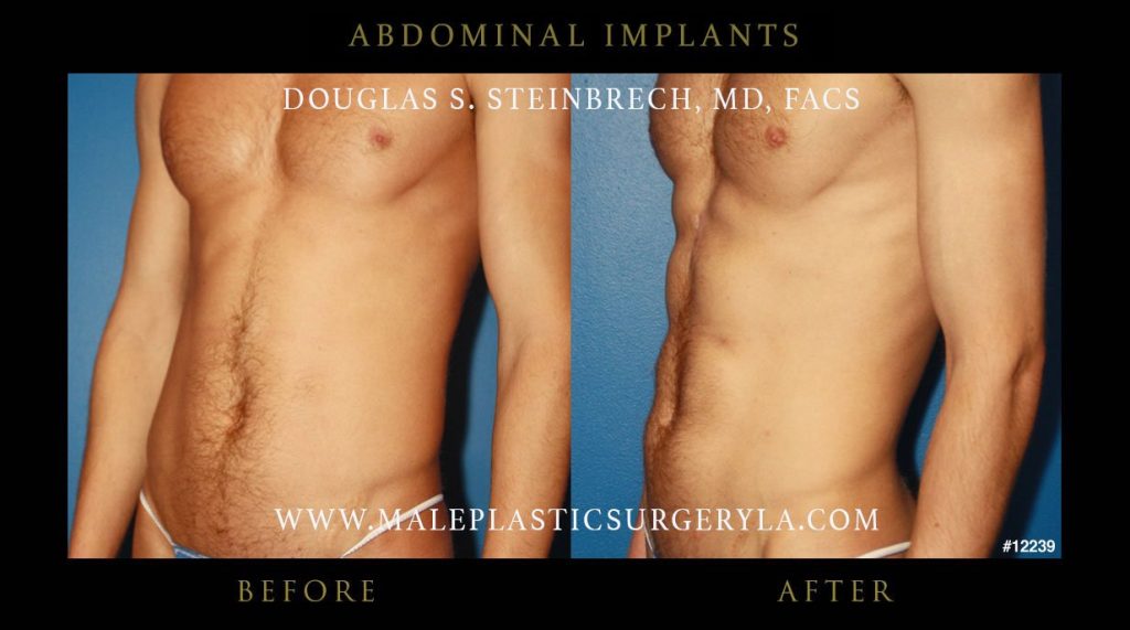 can you get ab implants?