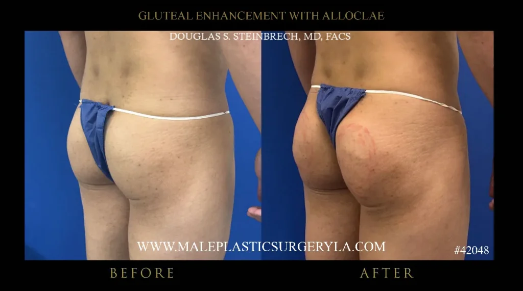 Before and after images of male gluteal enhancement surgery showcasing improved contours and volume, performed by Dr. Douglas Steinbrech at Male Plastic Surgery Los Angeles.