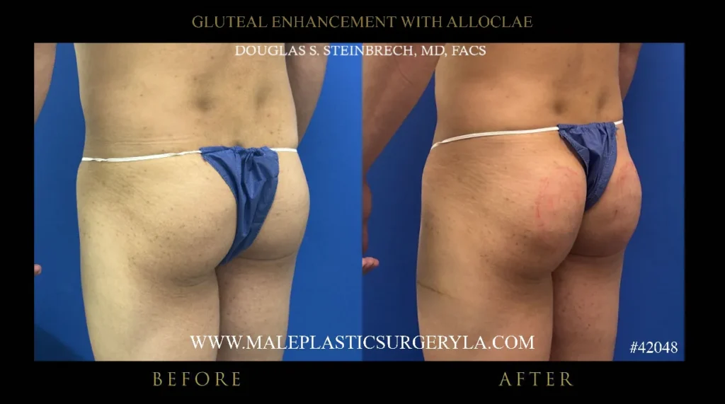 Before and after image of male gluteal enhancement procedure showcasing improved shape and contour, highlighting results of AlloClae treatment by Dr. Douglas Steinbrech.