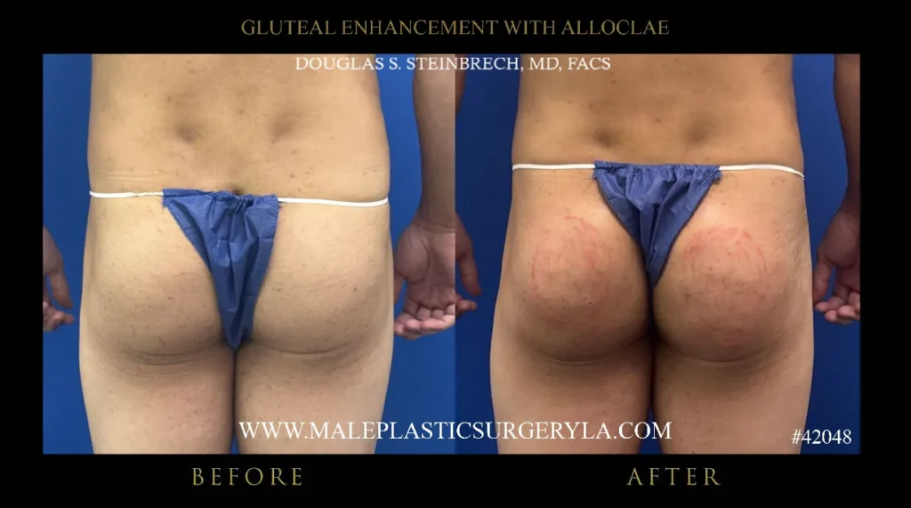 Before and after images showcasing gluteal enhancement procedure results for male patients at Male Plastic Surgery Los Angeles.