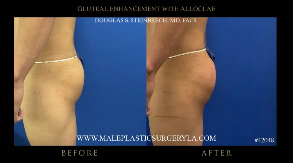 Before and after images of male gluteal enhancement showcasing improved contours and volume, highlighting the results of AlloClae procedure by Dr. Douglas Steinbrech in Los Angeles.