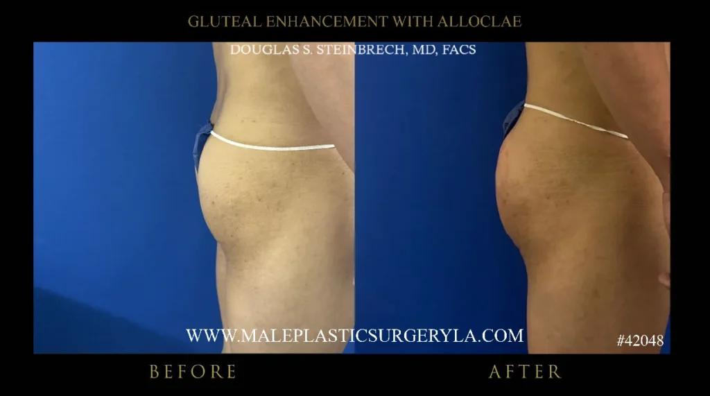 Before and after images of male gluteal enhancement procedure showcasing improved contour and volume, emphasizing surgical results by Dr. Douglas Steinbrech at Male Plastic Surgery Los Angeles.